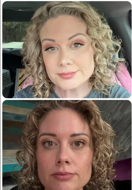 Botox mal aplicado en Medellín — caso 3, foto de referencia