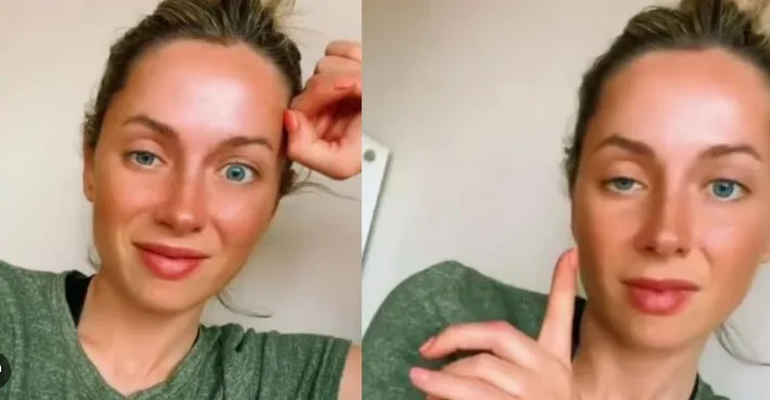 Botox mal aplicado en Medellín — caso 4, foto de referencia