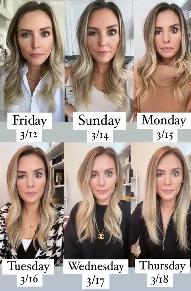 botox mal aplicado fotos